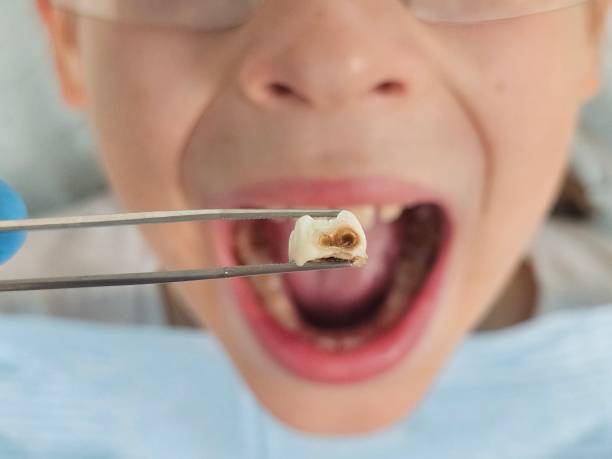 Best Emergency Wisdom Teeth Removal in Cedar Springs, MI